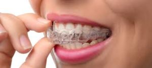 Invisalign Invisible Braces Treatment in Dubai - Best Dentist Dubai- Best Dentist - Dental Clinic Deira