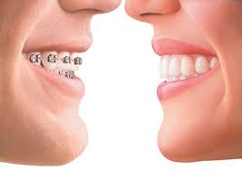 Invisalign Dubai - Dental Clinic in Deira Dubai - Cheap and best Invisalign Treatment in Dubai - Affordable Invisible braces