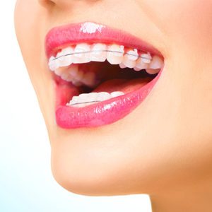 Dentist Dubai - Best Ceramic Braces Treatment in Dubai | Dental Clinic Deira Dubai -Best Orthodontist in Dubai- Dr. Nazeer