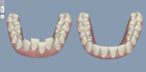 Clear aligners - Orthodontix Dental Clinic Deira Dubai - Cheapest and Best Invisalign treatment in Dubai U.A.E | Invisalign soft ware Clin-check in Dubai