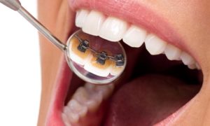 Best Lingual Braces in Chennai