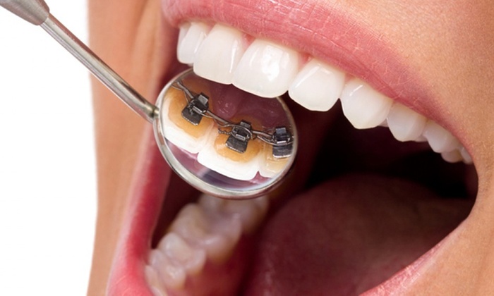 Lingual Braces in Dubai - Orthodontix Dental Clinic