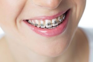 Cheapest and best braces Dubai - Metal Braces Treatment in Dubai - Dentist Deira -Best orthodontic braces Treatment in Dubai | Braces Cost Dubai