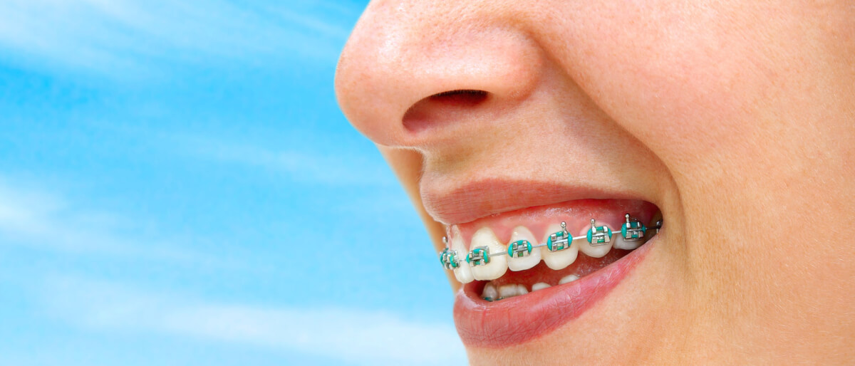 Do You Have Space-Age Wire in Your Braces? - Charleston Orthodontics  Powered By Smile Doctors