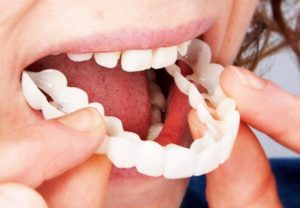 Snap On Smile at Orthodontix Dental Clinic - Cheapest and Best Snap on smile  in Dubai