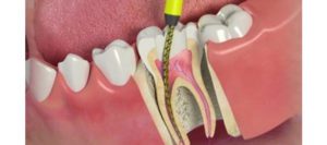 Cheapest and Best Root Canal Treatment in Dubai - Best dentist in Deira Dubai - Orthodontix Dental Clinic