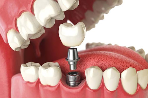 Cheapest and Best High Quality Dental Implant in Dubai