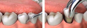Cheapest and best affordable teeth extraction in Dubai - Teeth removal dentist cost Deira